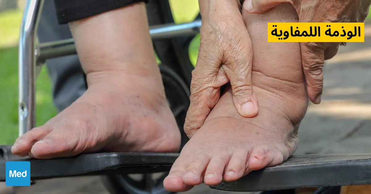 الوذمة اللمفاوية